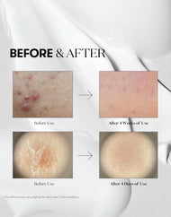 VT Collagen Reedle Shot 300